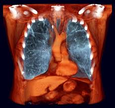 chronic-obstructive-pulmonary-disease